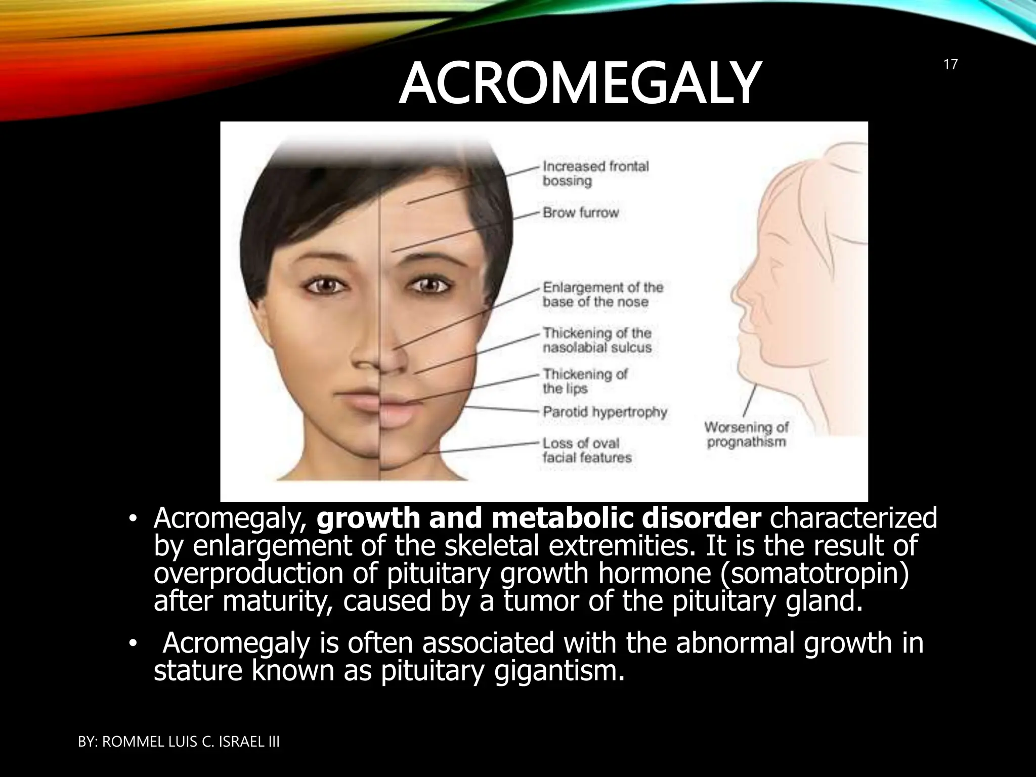 ACROMEGALY
• Acromegaly, growth and metabolic disorder characterized
by enlargement of the skeletal extremities. It is the result of
overproduction of pituitary growth hormone (somatotropin)
after maturity, caused by a tumor of the pituitary gland.
• Acromegaly is often associated with the abnormal growth in
stature known as pituitary gigantism.
BY: ROMMEL LUIS C. ISRAEL III
17
 