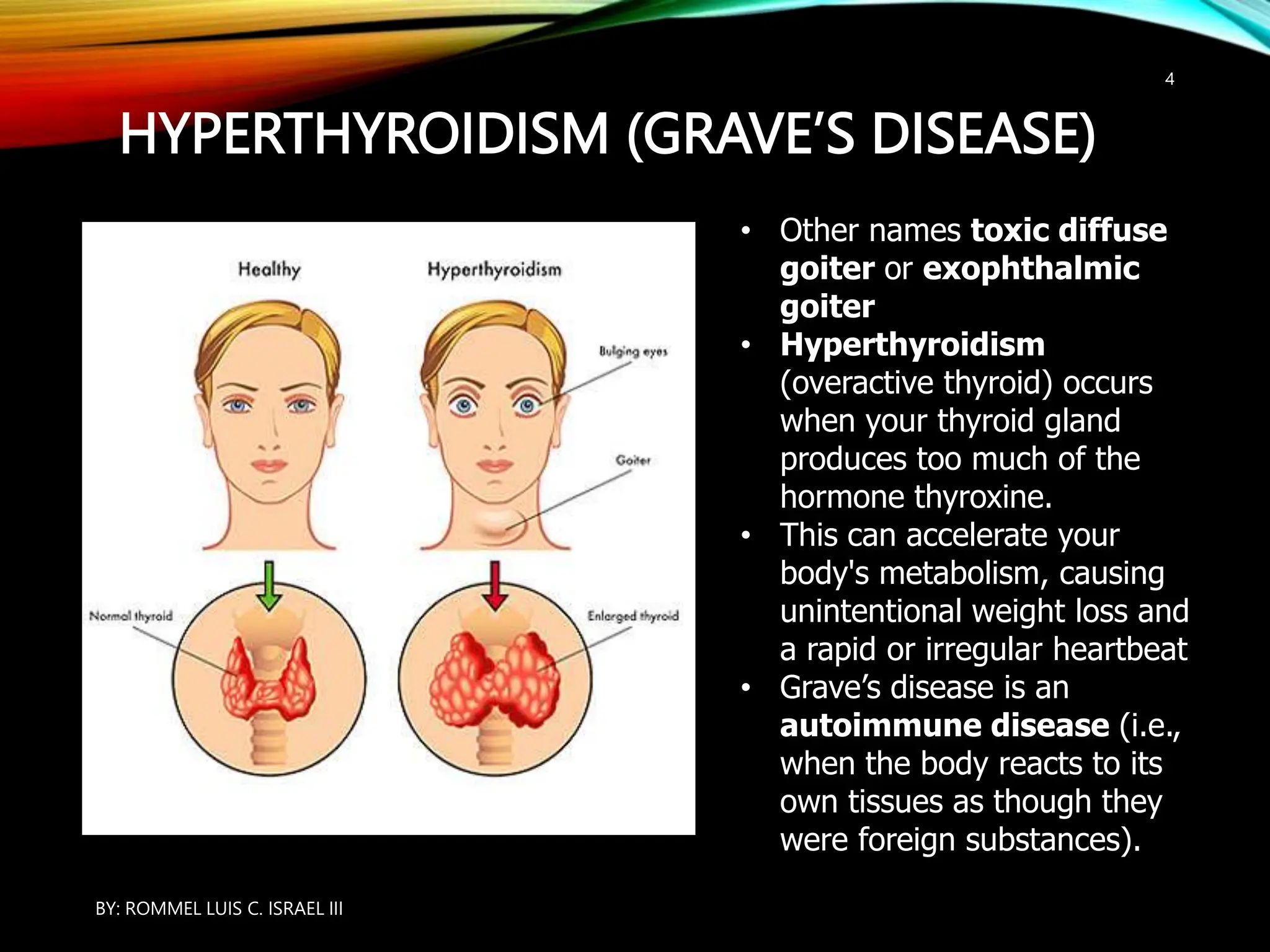 HYPERTHYROIDISM (GRAVE’S DISEASE)
• Other names toxic diffuse
goiter or exophthalmic
goiter
• Hyperthyroidism
(overactive thyroid) occurs
when your thyroid gland
produces too much of the
hormone thyroxine.
• This can accelerate your
body's metabolism, causing
unintentional weight loss and
a rapid or irregular heartbeat
• Grave’s disease is an
autoimmune disease (i.e.,
when the body reacts to its
own tissues as though they
were foreign substances).
BY: ROMMEL LUIS C. ISRAEL III
4
 