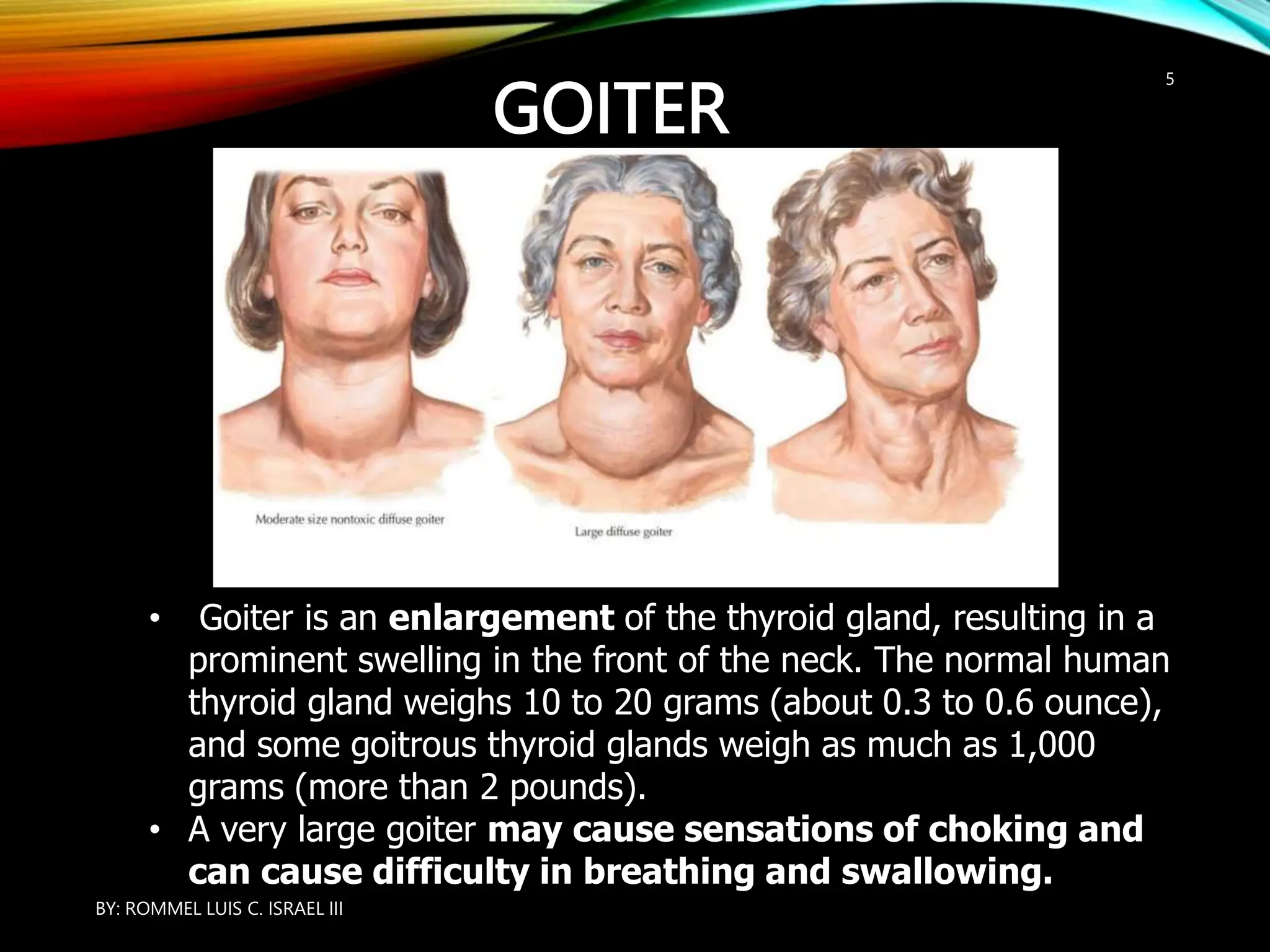 GOITER
• Goiter is an enlargement of the thyroid gland, resulting in a
prominent swelling in the front of the neck. The normal human
thyroid gland weighs 10 to 20 grams (about 0.3 to 0.6 ounce),
and some goitrous thyroid glands weigh as much as 1,000
grams (more than 2 pounds).
• A very large goiter may cause sensations of choking and
can cause difficulty in breathing and swallowing.
BY: ROMMEL LUIS C. ISRAEL III
5
 