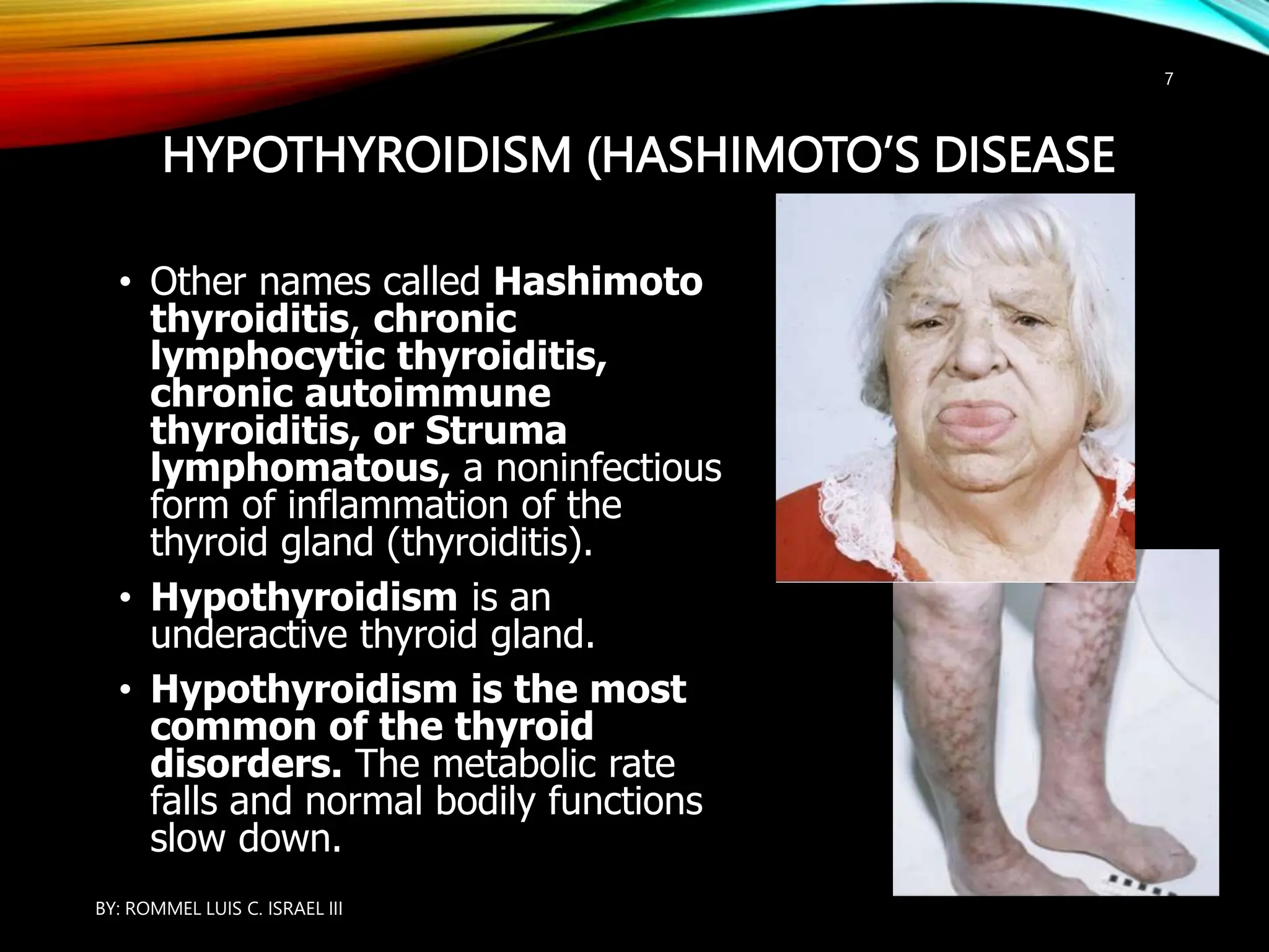 HYPOTHYROIDISM (HASHIMOTO’S DISEASE
• Other names called Hashimoto
thyroiditis, chronic
lymphocytic thyroiditis,
chronic autoimmune
thyroiditis, or Struma
lymphomatous, a noninfectious
form of inflammation of the
thyroid gland (thyroiditis).
• Hypothyroidism is an
underactive thyroid gland.
• Hypothyroidism is the most
common of the thyroid
disorders. The metabolic rate
falls and normal bodily functions
slow down.
BY: ROMMEL LUIS C. ISRAEL III
7
 