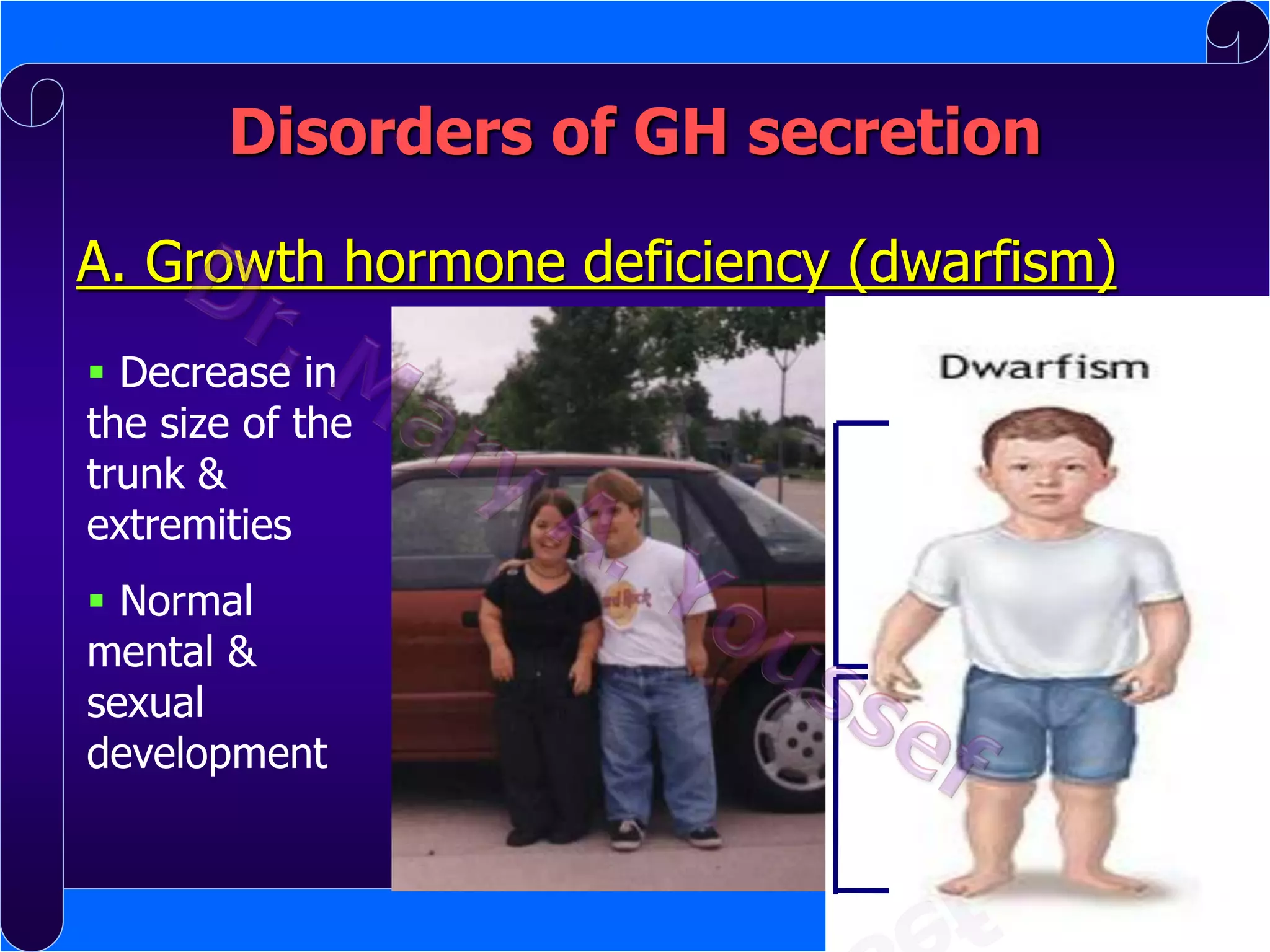 Disorders of GH secretion
A. Growth hormone deficiency (dwarfism)
 Decrease in
the size of the
trunk &
extremities
 Normal
mental &
sexual
development

 