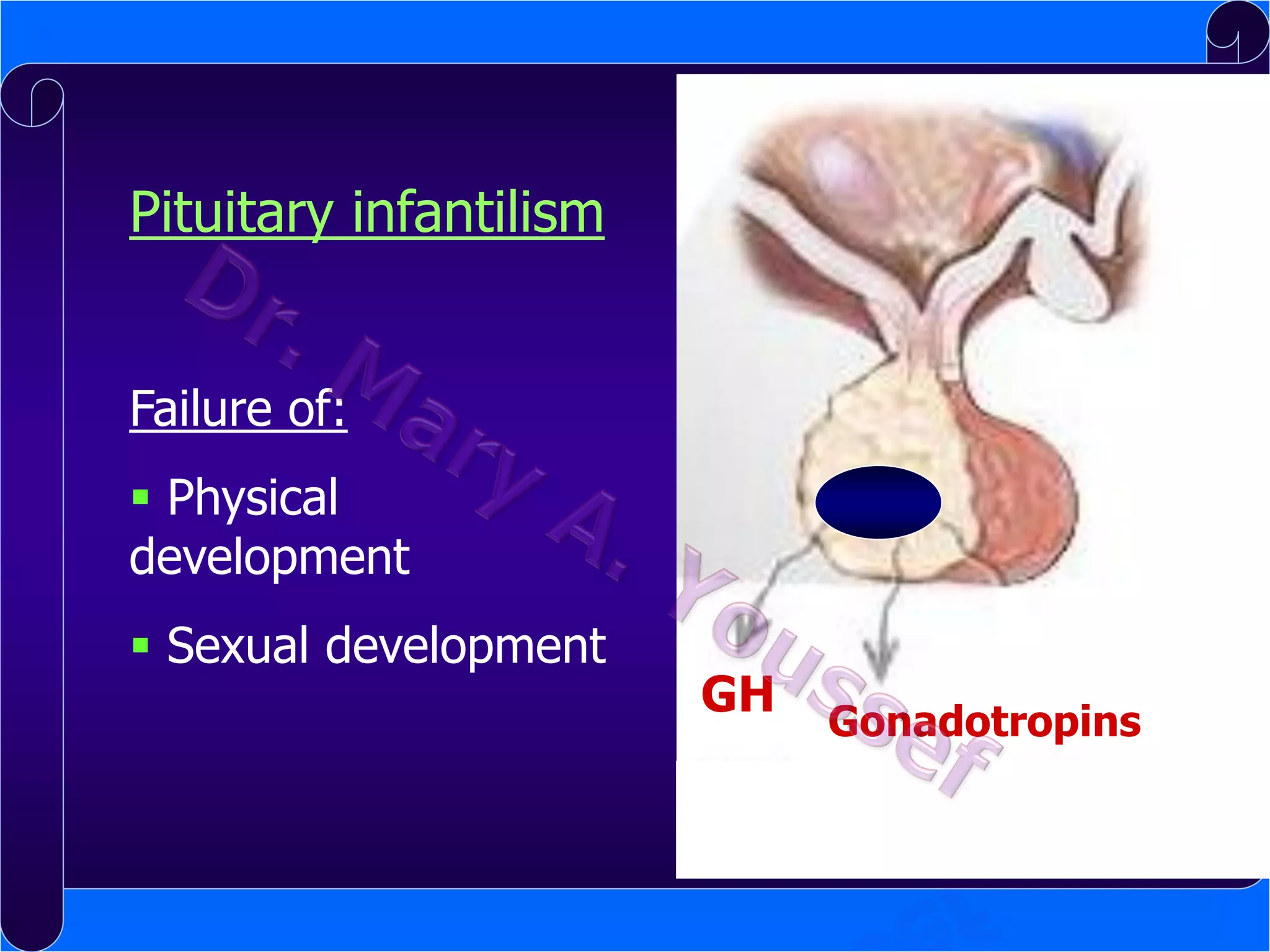 Pituitary infantilism
Failure of:
 Physical
development

 Sexual development

GH

Gonadotropins

 