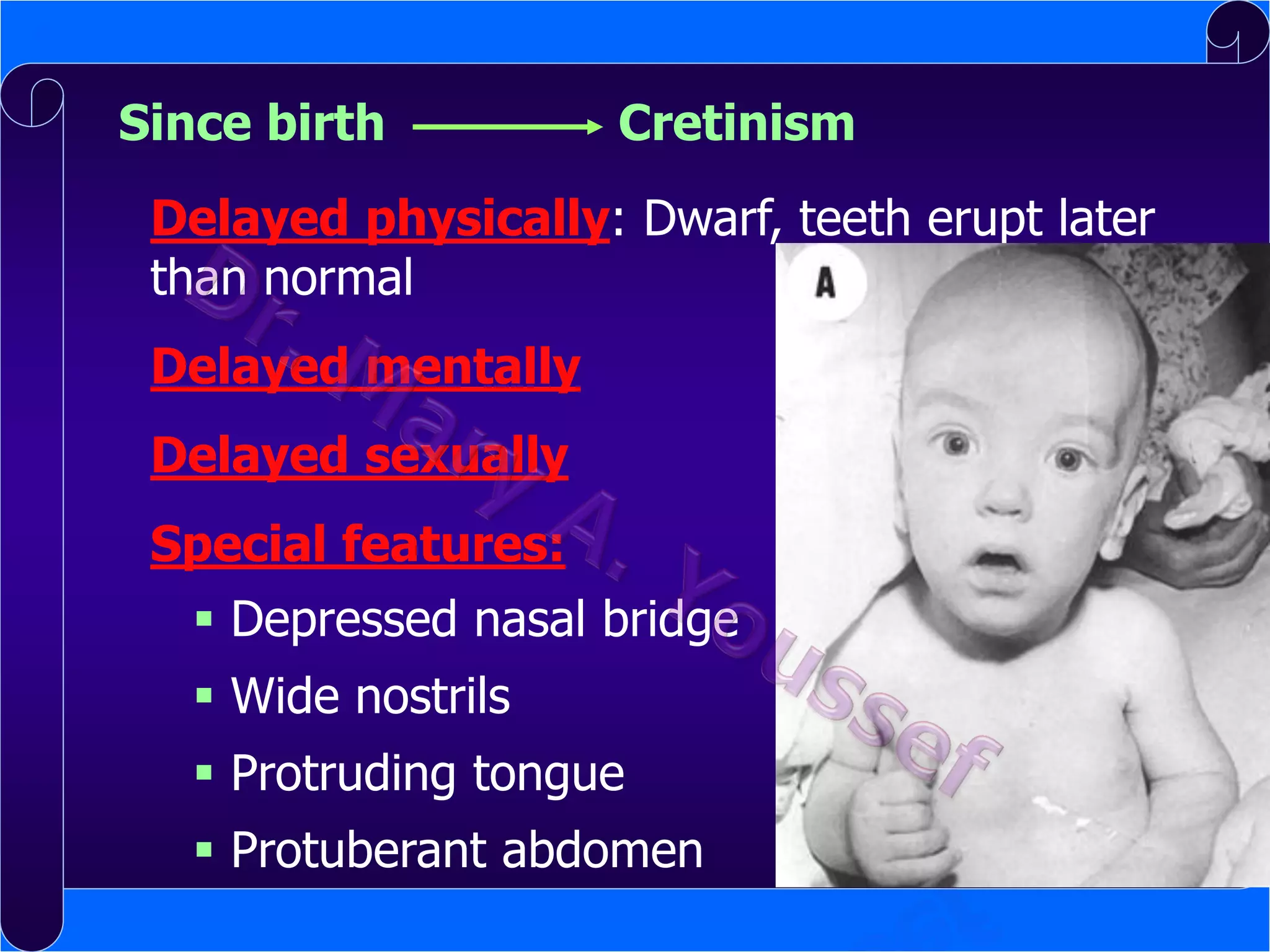 Since birth

Cretinism

Delayed physically: Dwarf, teeth erupt later
than normal
Delayed mentally

Delayed sexually
Special features:
 Depressed nasal bridge
 Wide nostrils
 Protruding tongue
 Protuberant abdomen

 
