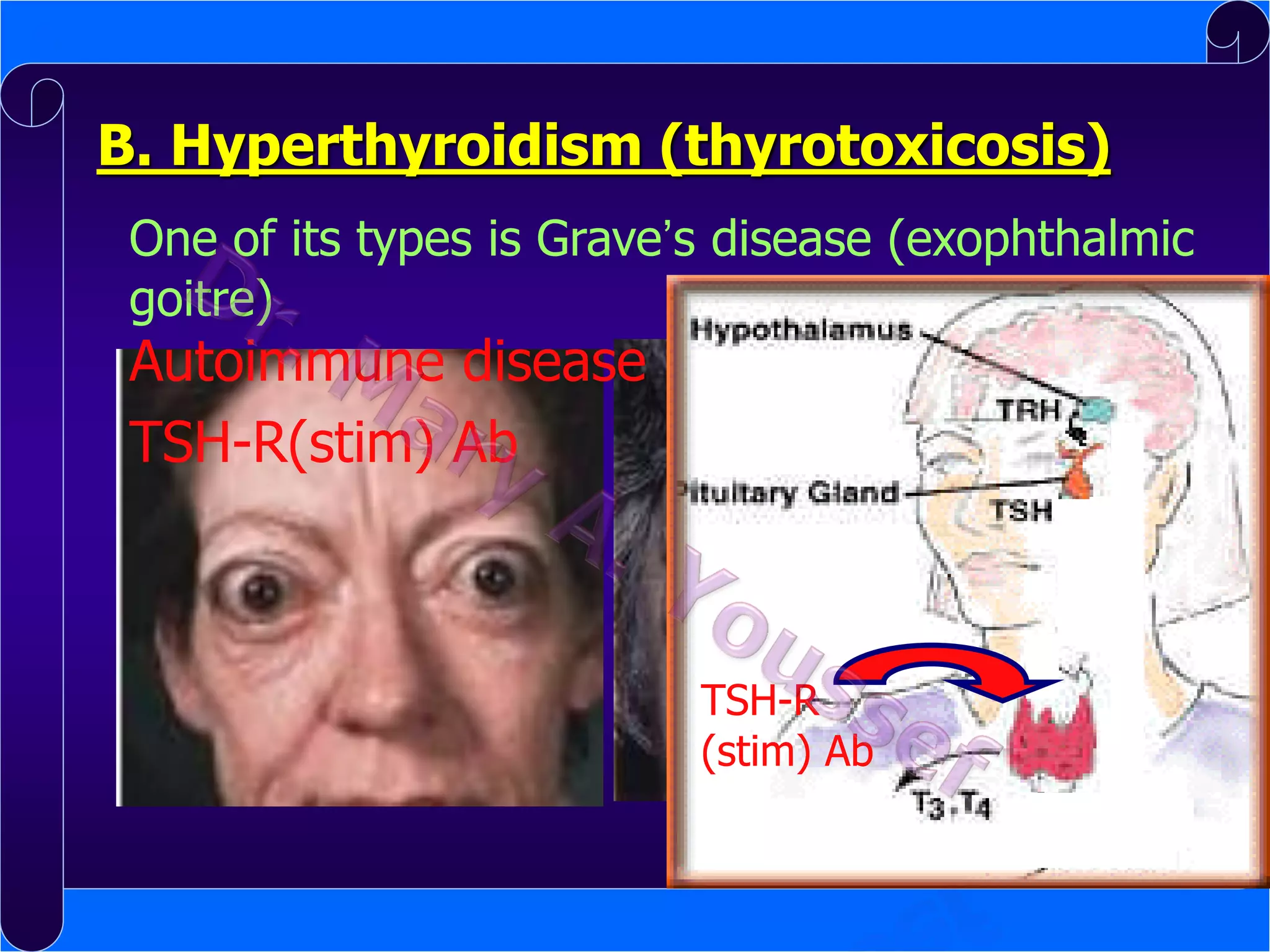B. Hyperthyroidism (thyrotoxicosis)
One of its types is Grave’s disease (exophthalmic
goitre)

Autoimmune disease
TSH-R(stim) Ab

TSH-R
(stim) Ab

 