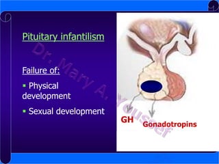 Pituitary infantilism
Failure of:
 Physical
development

 Sexual development

GH

Gonadotropins

 