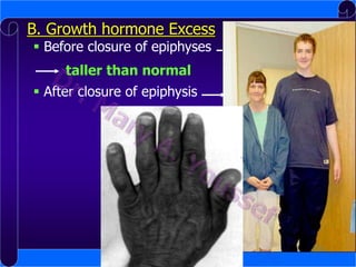 B. Growth hormone Excess
 Before closure of epiphyses

Gigantism

taller than normal
 After closure of epiphysis

Acromegaly

 