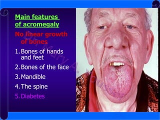 Main features
of acromegaly

No linear growth
of bones
1. Bones of hands
and feet
2. Bones of the face

3. Mandible
4. The spine
5. Diabetes

 