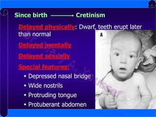 Since birth

Cretinism

Delayed physically: Dwarf, teeth erupt later
than normal
Delayed mentally

Delayed sexually
Special features:
 Depressed nasal bridge
 Wide nostrils
 Protruding tongue
 Protuberant abdomen

 