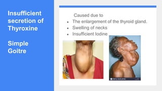 Insufficient
secretion of
Thyroxine
Simple
Goitre
Caused due to
● The enlargement of the thyroid gland.
● Swelling of necks
● Insufficient Iodine
 