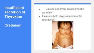 Insufficient
secretion of
Thyroxine
Cretinism
● Causes abnormal development in
an infant
● It causes both physical and mental
retardation.
 