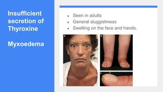 Insufficient
secretion of
Thyroxine
Myxoedema
● Seen in adults
● General sluggishness
● Swelling on the face and hands.
 
