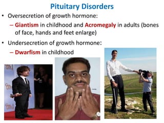Pituitary Disorders
• Oversecretion of growth hormone:
– Giantism in childhood and Acromegaly in adults (bones
of face, hands and feet enlarge)
• Undersecretion of growth hormone:
– Dwarfism in childhood
 