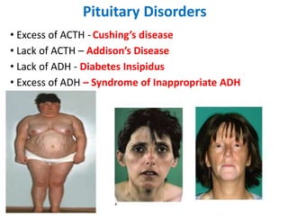 Pituitary Disorders
• Excess of ACTH -Cushing’s disease
• Lack of ACTH – Addison’s Disease
• Lack of ADH - Diabetes Insipidus
• Excess of ADH – Syndrome of Inappropriate ADH
 