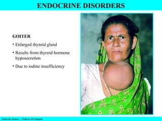 ENDOCRINE DISORDERS

GOITER
• Enlarged thyroid gland
• Results from thyroid hormone
hyposecretion
• Due to iodine insufficiency

Endocrine System…. Professor KS Satyapal

 