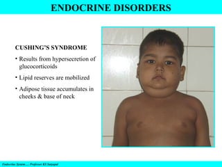 ENDOCRINE DISORDERS

CUSHING’S SYNDROME
• Results from hypersecretion of
glucocorticoids
• Lipid reserves are mobilized
• Adipose tissue accumulates in
cheeks & base of neck

Endocrine System…. Professor KS Satyapal

 