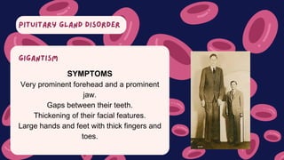 PITUITARY GLAND DISORDER
SYMPTOMS
Very prominent forehead and a prominent
jaw.
Gaps between their teeth.
Thickening of their facial features.
Large hands and feet with thick fingers and
toes.
GIGANTISM
 