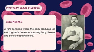 PITUITARY GLAND DISORDER
A rare condition where the body produces too
much growth hormone, causing body tissues
and bones to growth more.
ACROMEGALY
 