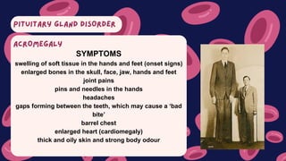 PITUITARY GLAND DISORDER
SYMPTOMS
swelling of soft tissue in the hands and feet (onset signs)
enlarged bones in the skull, face, jaw, hands and feet
joint pains
pins and needles in the hands
headaches
gaps forming between the teeth, which may cause a ‘bad
bite’
barrel chest
enlarged heart (cardiomegaly)
thick and oily skin and strong body odour
ACROMEGALY
 