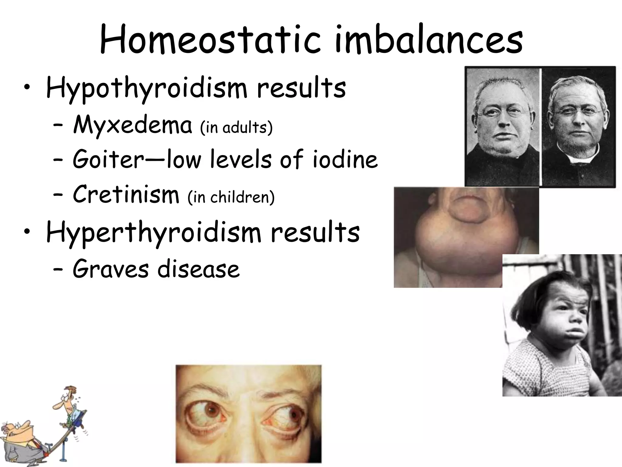 Homeostatic imbalances
• Hypothyroidism results
  – Myxedema (in adults)
  – Goiter—low levels of iodine
  – Cretinism (in children)
• Hyperthyroidism results
  – Graves disease
 