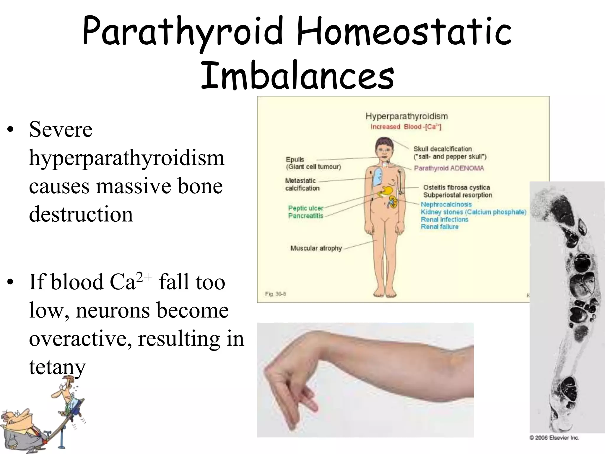 Parathyroid Homeostatic
              Imbalances
• Severe
  hyperparathyroidism
  causes massive bone
  destruction

• If blood Ca2+ fall too
  low, neurons become
  overactive, resulting in
  tetany
 