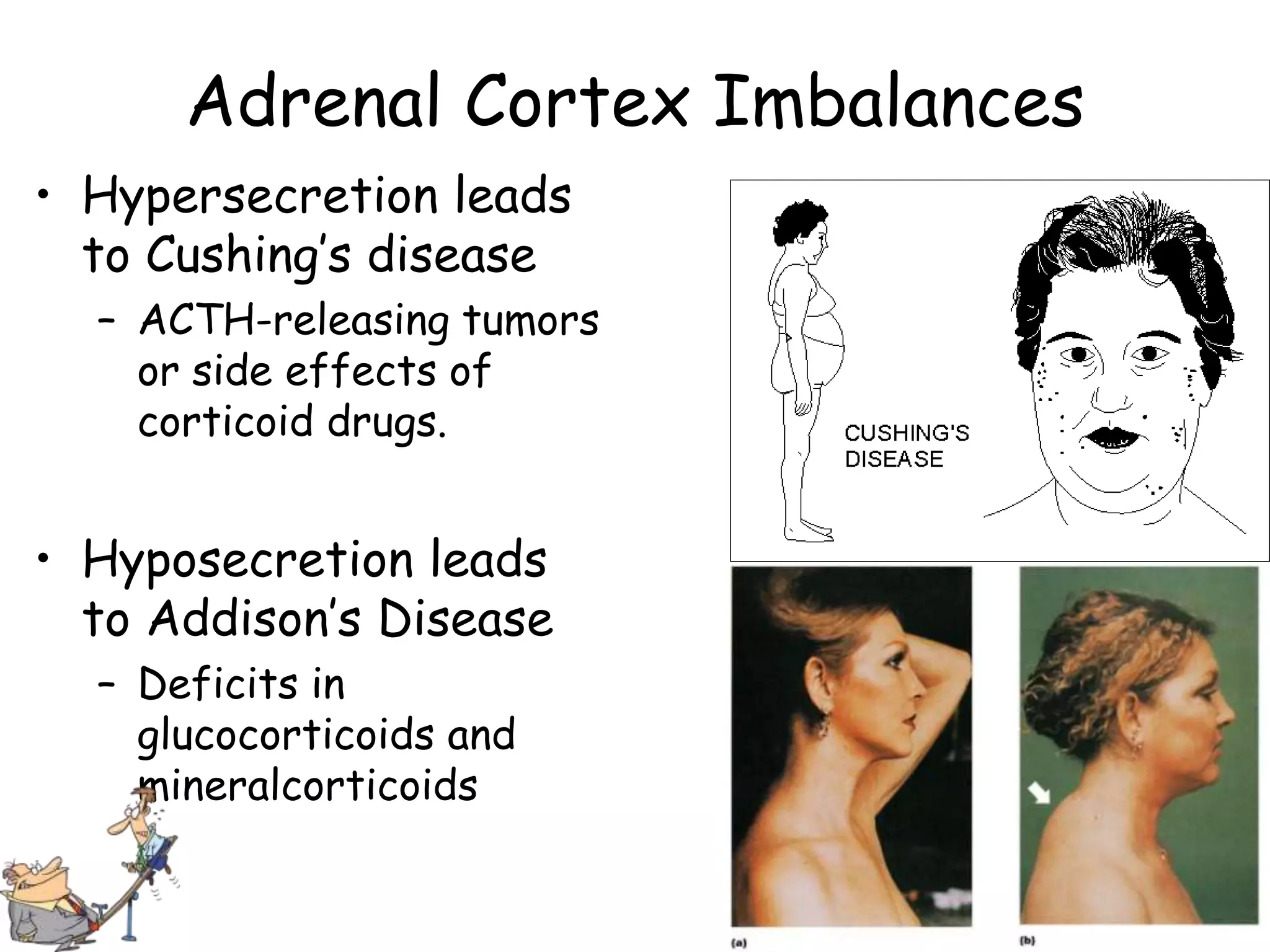 Adrenal Cortex Imbalances
• Hypersecretion leads
  to Cushing’s disease
  – ACTH-releasing tumors
    or side effects of
    corticoid drugs.


• Hyposecretion leads
  to Addison’s Disease
  – Deficits in
    glucocorticoids and
    mineralcorticoids
 