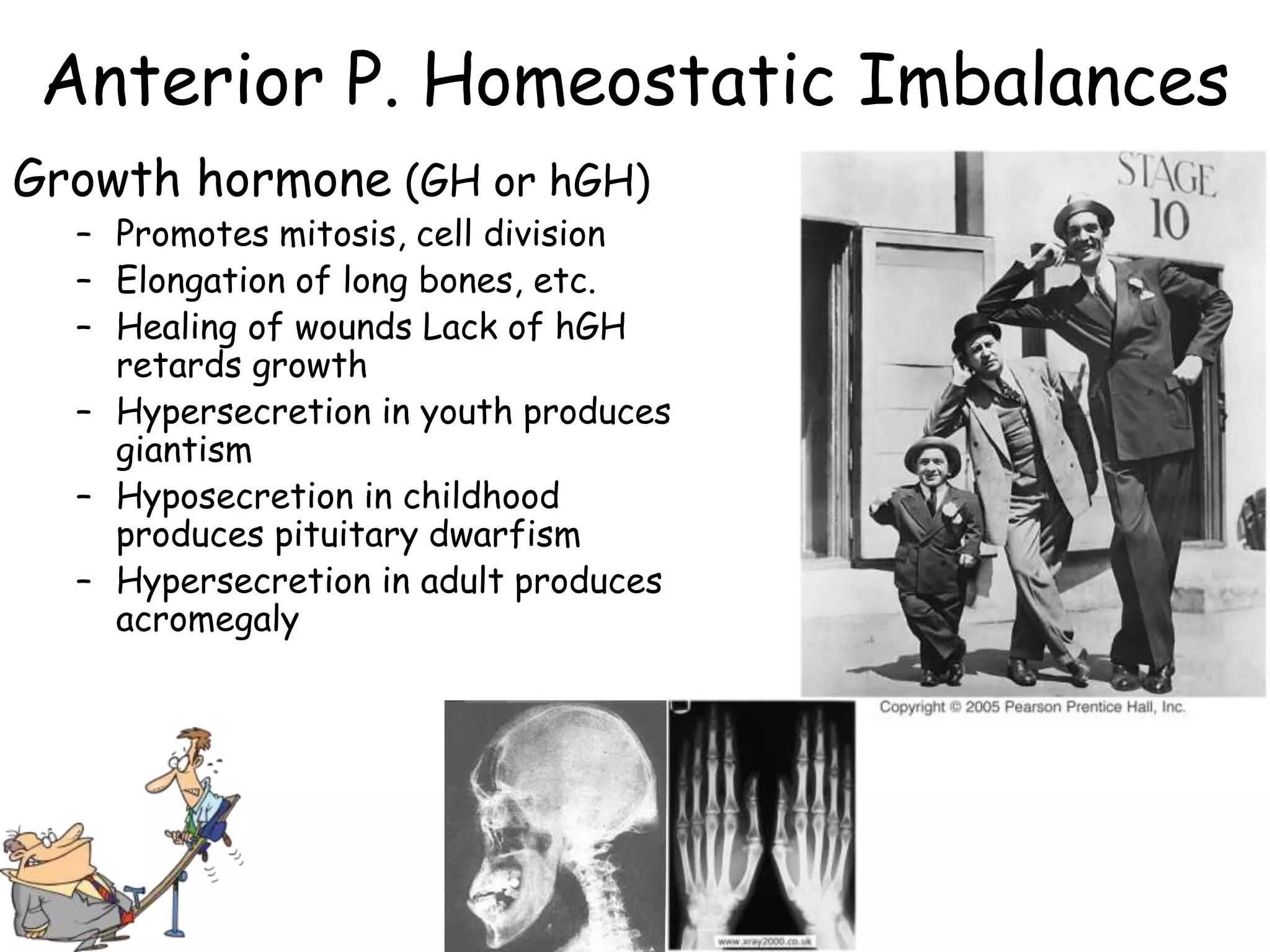 Anterior P. Homeostatic Imbalances
Growth hormone (GH or hGH)
  – Promotes mitosis, cell division
  – Elongation of long bones, etc.
  – Healing of wounds Lack of hGH
    retards growth
  – Hypersecretion in youth produces
    giantism
  – Hyposecretion in childhood
    produces pituitary dwarfism
  – Hypersecretion in adult produces
    acromegaly
 