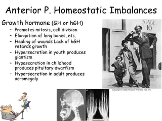 Anterior P. Homeostatic Imbalances
Growth hormone (GH or hGH)
  – Promotes mitosis, cell division
  – Elongation of long bones, etc.
  – Healing of wounds Lack of hGH
    retards growth
  – Hypersecretion in youth produces
    giantism
  – Hyposecretion in childhood
    produces pituitary dwarfism
  – Hypersecretion in adult produces
    acromegaly
 