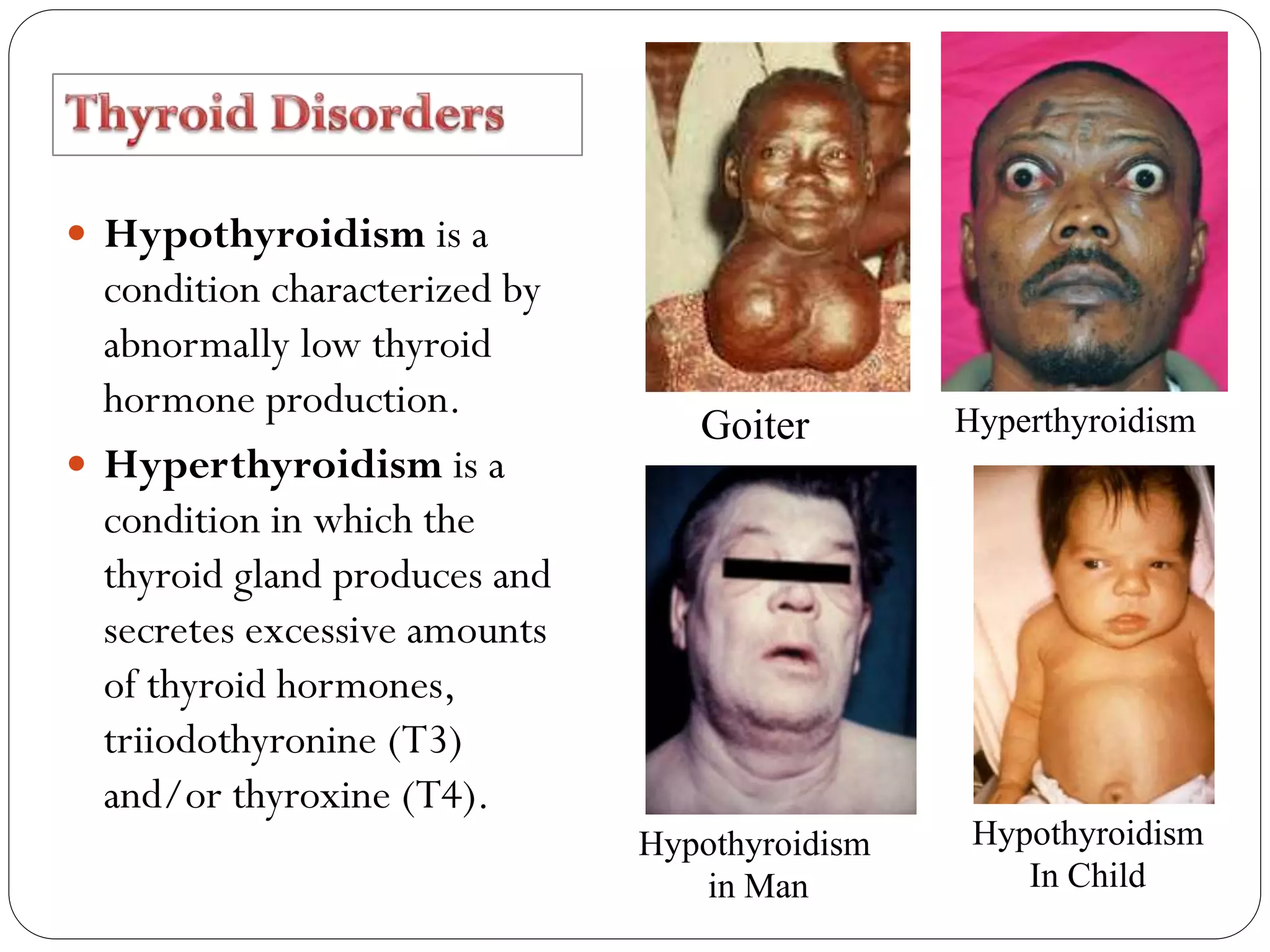  Hypothyroidism is a
condition characterized by
abnormally low thyroid
hormone production.
 Hyperthyroidism is a
condition in which the
thyroid gland produces and
secretes excessive amounts
of thyroid hormones,
triiodothyronine (T3)
and/or thyroxine (T4).
Goiter Hyperthyroidism
Hypothyroidism
in Man
Hypothyroidism
In Child
 