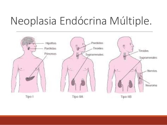neoplasia endocrina multiple