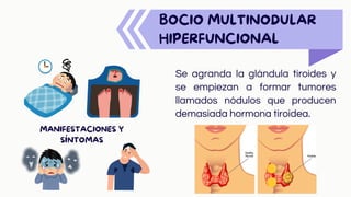BOCIO MULTINODULAR
HIPERFUNCIONAL
Se agranda la glándula tiroides y
se empiezan a formar tumores
llamados nódulos que producen
demasiada hormona tiroidea.
MANIFESTACIONES Y
SÍNTOMAS
 