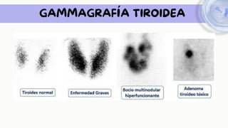 GAMMAGRAFÍA TIROIDEA
 