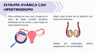 Esta entidad es muy rara. Surge en el
seno de tejido tiroideo ectópico
localizado en el ovario, y que luego se
hace hiperfuncional.
ESTRUMA OVÁRICO CON
HIPERTIROIDISMO
Algún caso similar se ha descrito con
teratoma testicular.
Deben ser extirpados, previa
preparación con antitiroideos.
 