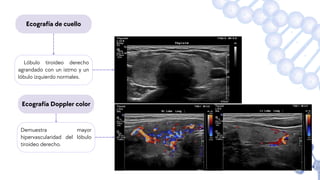 Ecografía de cuello
Lóbulo tiroideo derecho
agrandado con un istmo y un
lóbulo izquierdo normales.
Demuestra mayor
hipervascularidad del lóbulo
tiroideo derecho.
Ecografía Doppler color
 