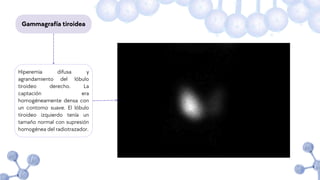 Gammagrafía tiroidea
Hiperemia difusa y
agrandamiento del lóbulo
tiroideo derecho. La
captación era
homogéneamente densa con
un contorno suave. El lóbulo
tiroideo izquierdo tenía un
tamaño normal con supresión
homogénea del radiotrazador.
 