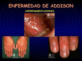 ENFERMEDAD DE ADDISON
     HIPERPIGMENTACIONES
 