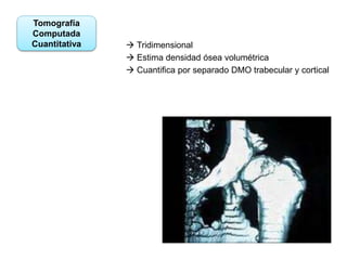 Tomografía
Computada
Cuantitativa  Tridimensional
 Estima densidad ósea volumétrica
 Cuantifica por separado DMO trabecular y cortical
 