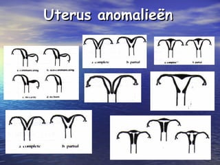 Uterus anomalieënUterus anomalieën
 