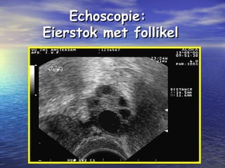 Echoscopie:Echoscopie:
Eierstok met follikelEierstok met follikel
 