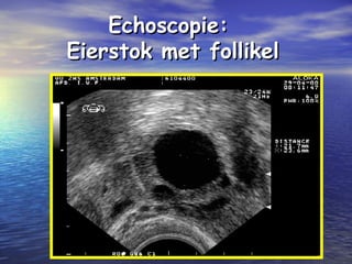 Echoscopie:Echoscopie:
Eierstok met follikelEierstok met follikel
 