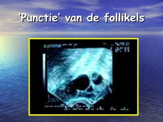 ‘‘Punctie’ van de follikelsPunctie’ van de follikels
 