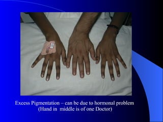 Excess Pigmentation – can be due to hormonal problem  (Hand in  middle is of one Doctor) 
