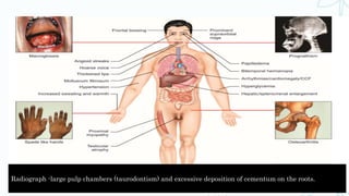 Radiograph -large pulp chambers (taurodontism) and excessive deposition of cementum on the roots.
 