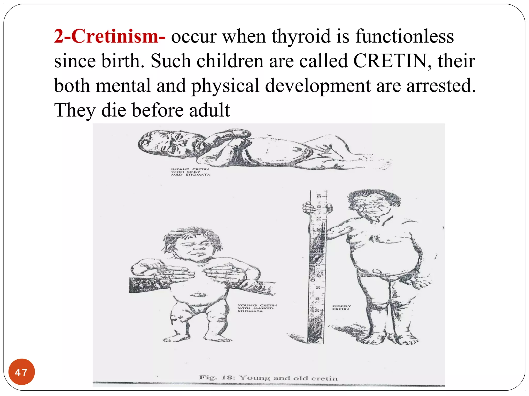2-Cretinism- occur when thyroid is functionless
since birth. Such children are called CRETIN, their
both mental and physical development are arrested.
They die before adult
47
 