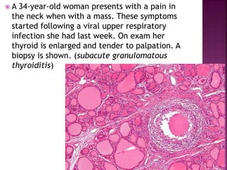  A 34-year-old woman presents with a pain in
the neck when with a mass. These symptoms
started following a viral upper respiratory
infection she had last week. On exam her
thyroid is enlarged and tender to palpation. A
biopsy is shown. (subacute granulomatous
thyroiditis)
 