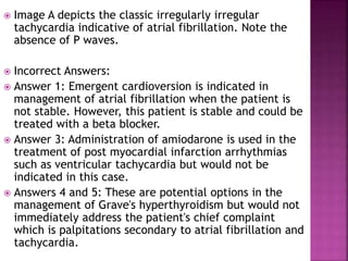 Image A depicts the classic irregularly irregular
tachycardia indicative of atrial fibrillation. Note the
absence of P waves.
 Incorrect Answers:
 Answer 1: Emergent cardioversion is indicated in
management of atrial fibrillation when the patient is
not stable. However, this patient is stable and could be
treated with a beta blocker.
 Answer 3: Administration of amiodarone is used in the
treatment of post myocardial infarction arrhythmias
such as ventricular tachycardia but would not be
indicated in this case.
 Answers 4 and 5: These are potential options in the
management of Grave's hyperthyroidism but would not
immediately address the patient's chief complaint
which is palpitations secondary to atrial fibrillation and
tachycardia.
 