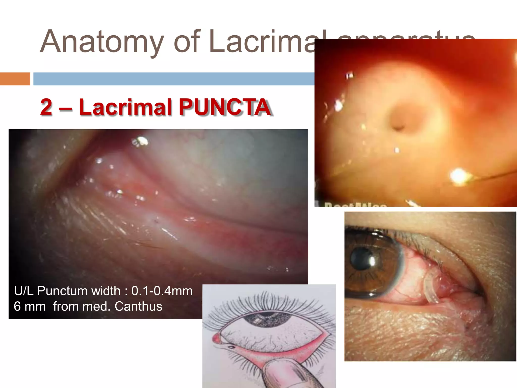 Anatomy of Lacrimal apparatus
2 – Lacrimal PUNCTA
U/L Punctum width : 0.1-0.4mm
6 mm from med. Canthus
 