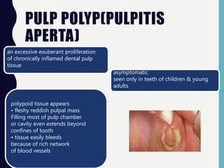 PULP POLYP(PULPITIS
APERTA)
an excessive exuberant proliferation
of chronically inflamed dental pulp
tissue
asymptomatic
seen only in teeth of children & young
adults
polypoid tissue appears
• fleshy reddish pulpal mass
Filling most of pulp chamber
or cavity even extends beyond
confines of tooth
• tissue easily bleeds
because of rich network
of blood vessels
 