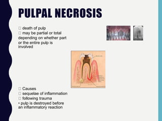 PULPAL NECROSIS
death of pulp
may be partial or total
depending on whether part
or the entire pulp is
involved
Causes
sequelae of inflammation
following trauma
• pulp is destroyed before
an inflammatory reaction
 