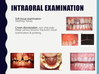 INTRAORAL EXAMINATION
Soft tissue examination:
Swelling/ fistula
Crown discoloration: non vital pulp
Deep carious lesions/ fractures: visual
examination & probing
 