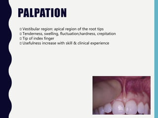 PALPATION
Vestibular region: apical region of the root tips
Tenderness, swelling, fluctuation,hardness, crepitation
Tip of index finger
Usefulness increase with skill & clinical experience
 